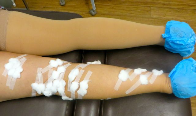Between front and back this was 52 injections.